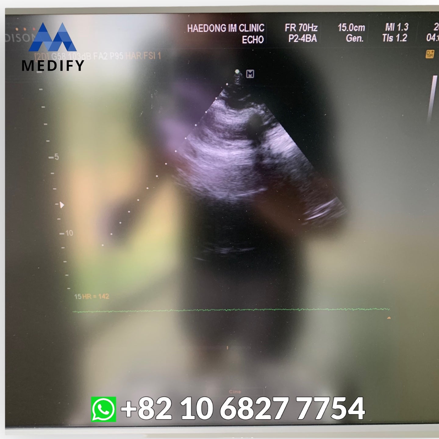 Samsung Medison EKO7 Ultrasound System & Cardiac Sector, Convex Probe - Worldwide