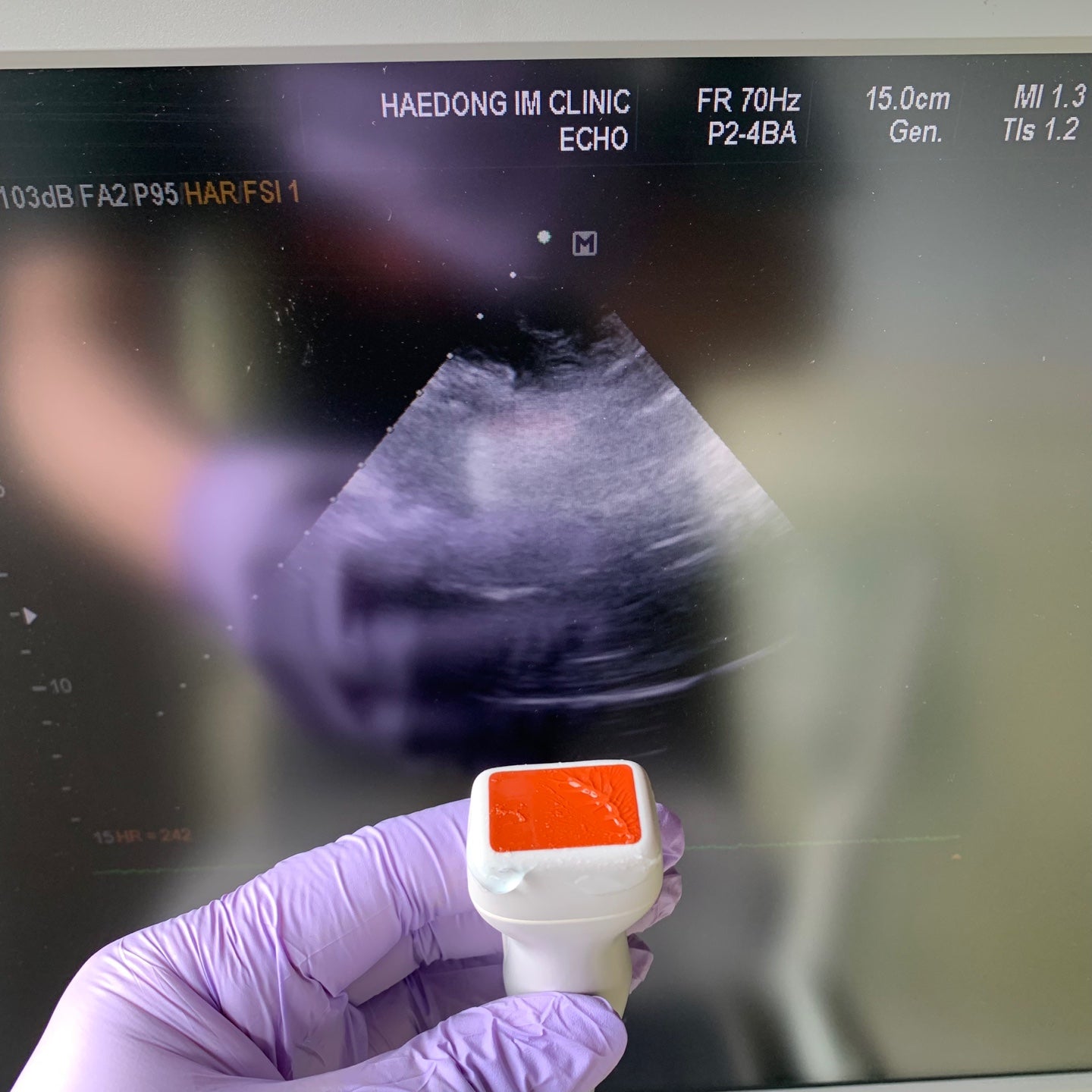Samsung Medison EKO7 Ultrasound System & Cardiac Sector, Convex Probe - Worldwide