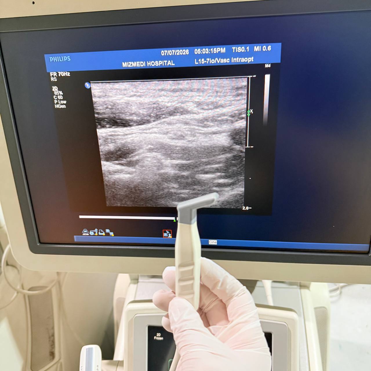 필립스 iU22 Ultrasound Machine - photo 24
